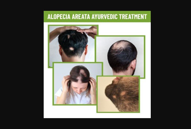 Ayurvedic Treatment for Alopecia